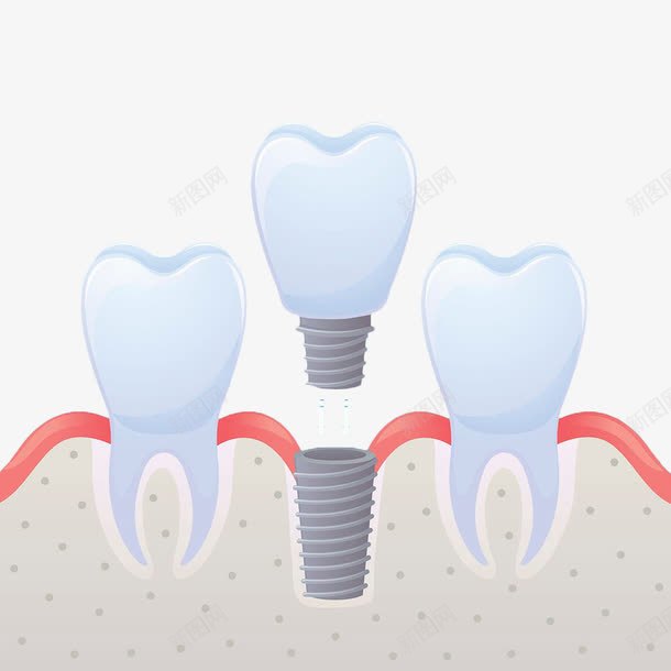 手绘牙齿牙套png免抠素材_新图网 https://ixintu.com 手绘 护齿 烤瓷牙 牙 牙套 白色 螺丝