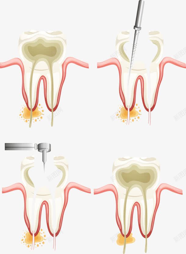 补牙过程png免抠素材_新图网 https://ixintu.com 牙齿 矢量牙齿 补牙 过程