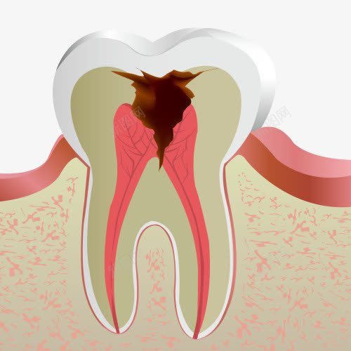 蛀牙牙痛坡面图png免抠素材_新图网 https://ixintu.com 牙医医生 牙痛 牙齿治疗 牙齿疼痛 蛀牙