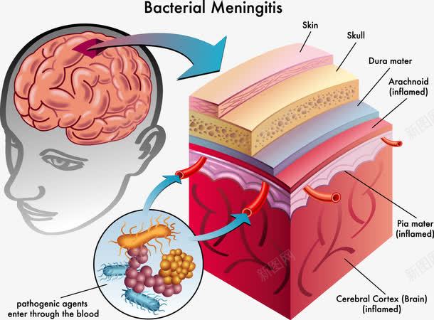 人体大脑脑膜炎细菌分析医学示意png免抠素材_新图网 https://ixintu.com 医学研究 脑膜炎 装饰