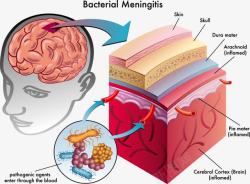 医学分析人体大脑脑膜炎细菌分析医学示意高清图片