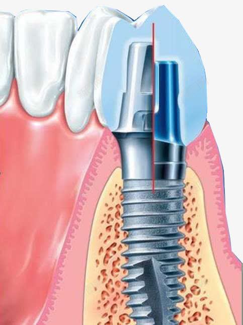 门牙种植png免抠素材_新图网 https://ixintu.com 假牙 牙齿 牙龈 牙龈健康刷牙防蛀牙 瓷牙 种植牙