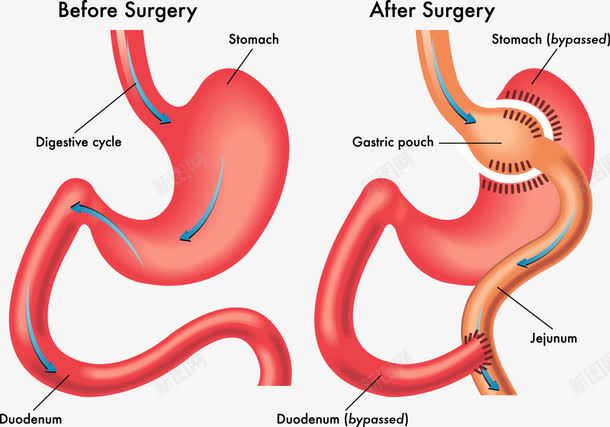 手术前后的肠胃变化png免抠素材_新图网 https://ixintu.com 人体胃部 医学研究 装饰