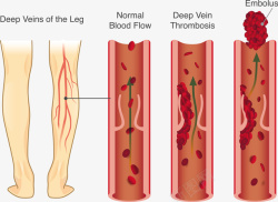 静脉曲张矢量图素材