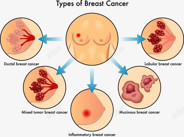 女性胸癌种类分析png免抠素材_新图网 https://ixintu.com 医学研究 胸癌分析 装饰