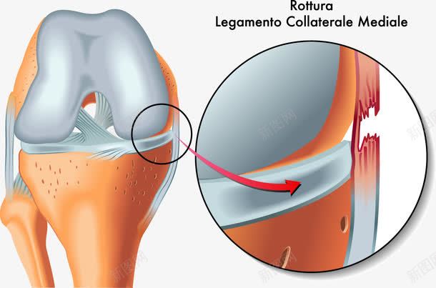 人体关节受伤示意图png免抠素材_新图网 https://ixintu.com 关节受伤 医学研究 装饰