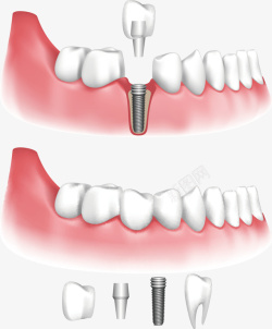 种牙PNG矢量图牙齿和牙龈矢量图高清图片
