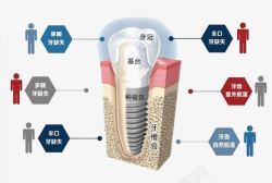 牙齿分解图素材