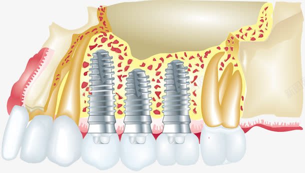 安装假牙png免抠素材_新图网 https://ixintu.com 安装假牙示意图 牙齿保健 牙齿美白 牙龈 牙龈健康刷牙防蛀牙