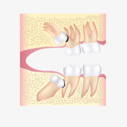卡通立体智齿导致的牙痛插画素材