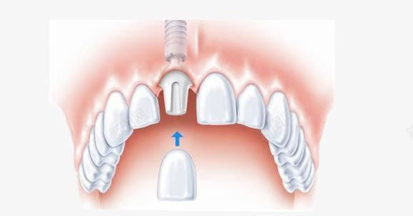 牙龈png免抠素材_新图网 https://ixintu.com 假牙 牙齿 牙龈 牙龈健康刷牙防蛀牙 瓷牙 种植牙