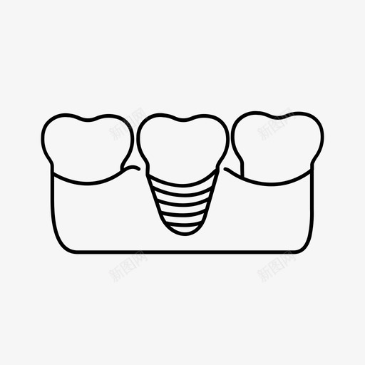 牙科植入物牙桥牙科护理图标svg_新图网 https://ixintu.com 牙桥 牙科护理 牙科植入物 牙齿