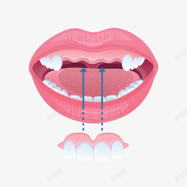 手绘门牙牙套png免抠素材_新图网 https://ixintu.com 手绘 护齿 烤瓷牙 牙 白色 箭头