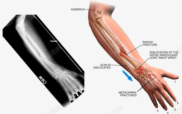 手臂扭伤png免抠素材_新图网 https://ixintu.com X光片 关节 医疗插图 手臂 扭伤