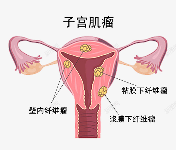 子宫肌瘤疾病psd免抠素材_新图网 https://ixintu.com 不健康 医院 子宫肌瘤 病变