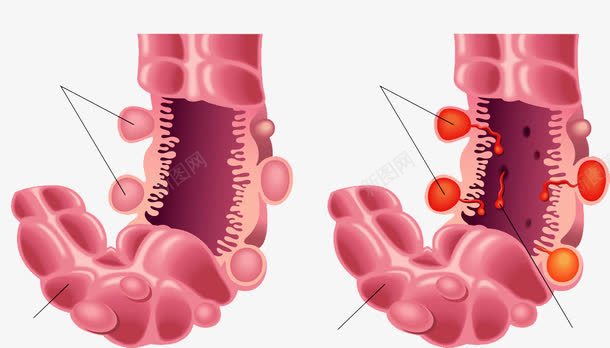 器官描绘png免抠素材_新图网 https://ixintu.com 人体器官感染描绘 感染描绘 断面描绘