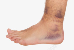 淤血脚部扭伤导致淤血青紫高清图片