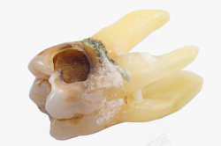 坏牙蛀牙牙洞素材