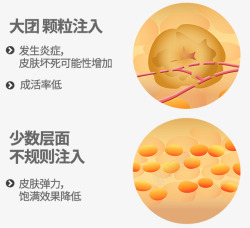 id脂肪移植纳米脂肪移植整体面部的自然饱满感塑造立素材