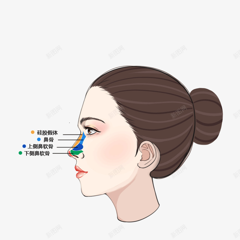 隆鼻假体隆鼻硅胶假体硅胶膨体png免抠素材_新图网 https://ixintu.com 隆鼻 假体 硅胶 膨体