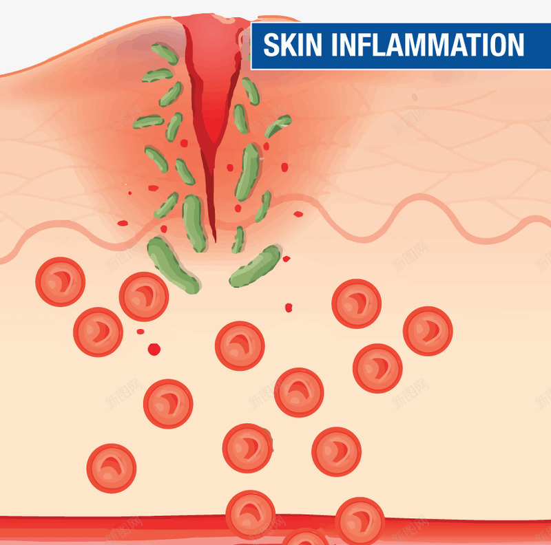 炎症如何帮助皮肤愈合png免抠素材_新图网 https://ixintu.com 炎症 如何 帮助 皮肤 愈合