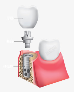 种植牙12素材