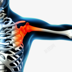 肩周炎疼痛图示png图片免费下载 素材7zyukwvva 新图网