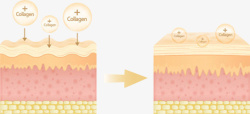 分子层粗糙皮肤和弹性皮肤对比图高清图片