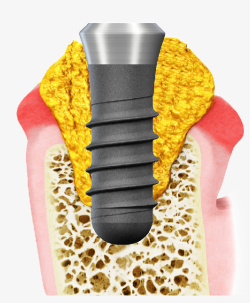 种植牙口腔牙齿素材