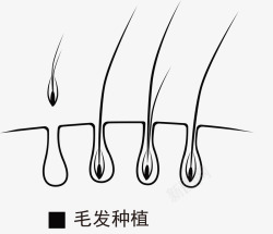 植发掉发素材