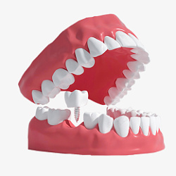 口腔种植牙齿种植模型高清图片