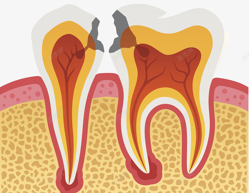 牙齿护理教科书插图png免抠素材_新图网 https://ixintu.com 医学治疗 口腔检查 插图 插画 教科书 牙医 牙齿护理 神经末梢 蛀牙