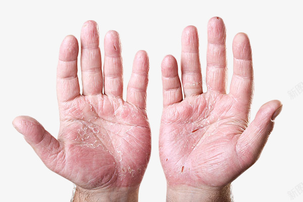 双手过敏png免抠素材_新图网 https://ixintu.com 健康 医疗医药 宣传 广告 手部 皮肤过敏 装饰