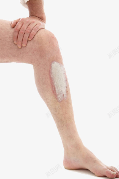 腿部过敏图png免抠素材_新图网 https://ixintu.com 医疗医药 宣传 广告 皮肤过敏 腿部 装饰