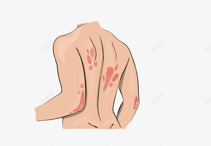 背部皮肤过敏png免抠素材_新图网 https://ixintu.com 医疗医药 卡通手绘 宣传 皮肤表皮 皮肤过敏 背部过敏 装饰