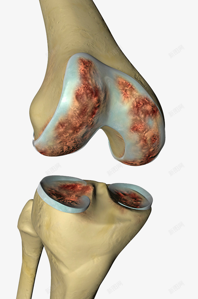 膝盖骨头磨损png免抠素材_新图网 https://ixintu.com 健康 关节炎 效果图 骨头磨损