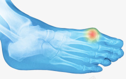 关节炎脚趾骨X光透视图高清图片