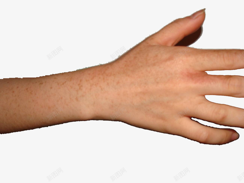 手部皮肤过敏症状图png免抠素材_新图网 https://ixintu.com 医学 手部 瘙痒 皮肤过敏