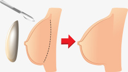 硅胶隆胸医学美容硅胶隆胸矢量图高清图片