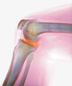软骨结构膝盖骨头磨损高清图片