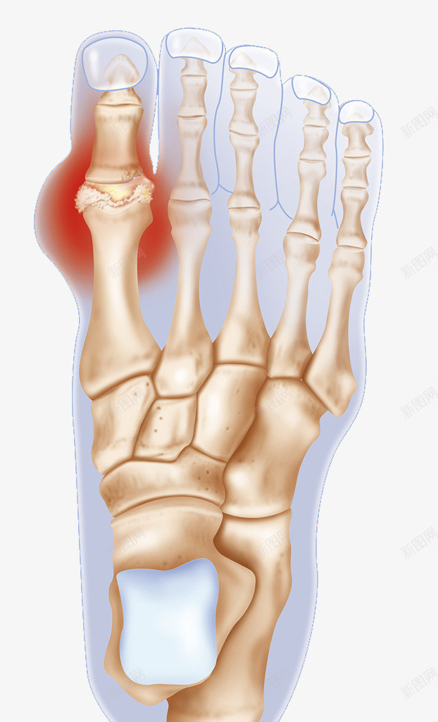 趾骨发炎炎症png免抠素材_新图网 https://ixintu.com 关节炎 炎症 肿胀 趾骨 骨头
