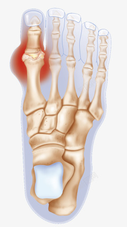 趾骨发炎炎症素材