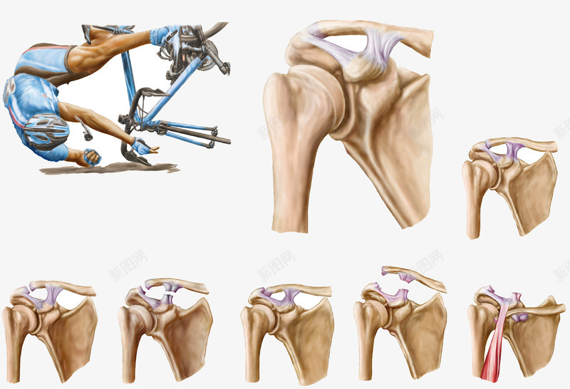 韧带骨头拉伤png免抠素材_新图网 https://ixintu.com 扭伤 运动摔伤 韧带损伤 骨头