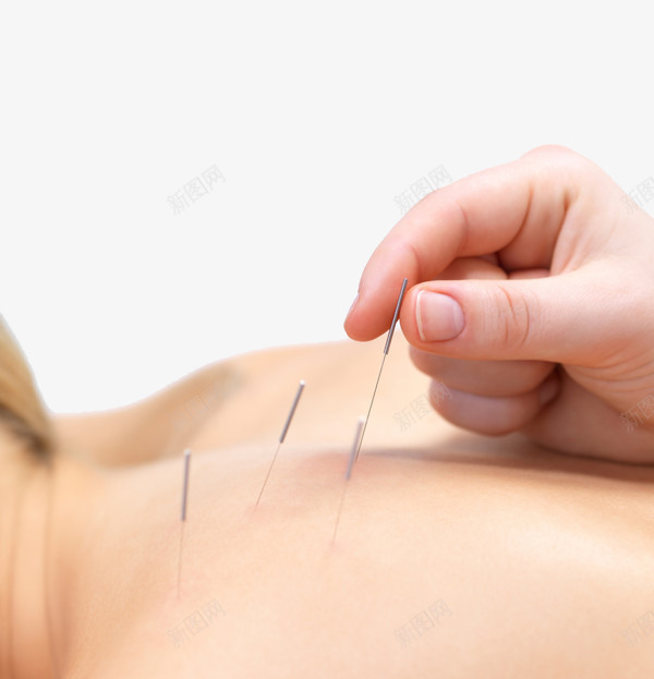 养身针灸png免抠素材_新图网 https://ixintu.com 养身 治疗 背部 背部写真 针灸 针灸疗法