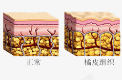 橘皮组织素材