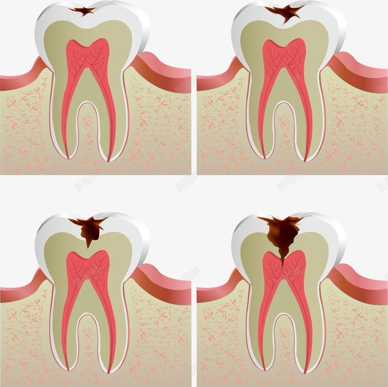 不同蛀牙程度效果图png免抠素材_新图网 https://ixintu.com 不同蛀牙程度效果图 矢量不同蛀牙程度效果图 矢量蛀牙 蛀牙效果图