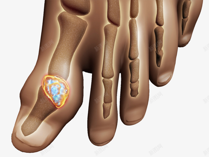 脚趾骨关节炎png免抠素材_新图网 https://ixintu.com 关节炎 医疗插图 脚趾骨 透视