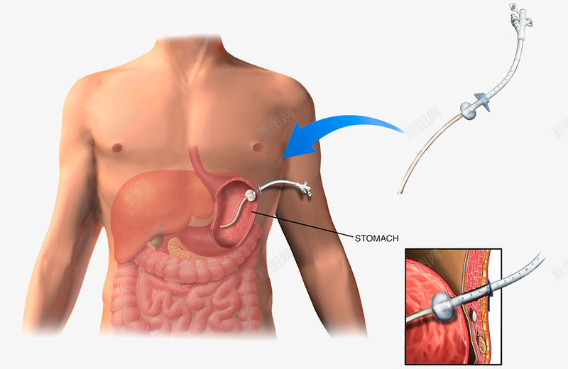 胃肠镜医疗插图png免抠素材_新图网 https://ixintu.com 人体器官 医疗插图 胃肠 胃肠镜