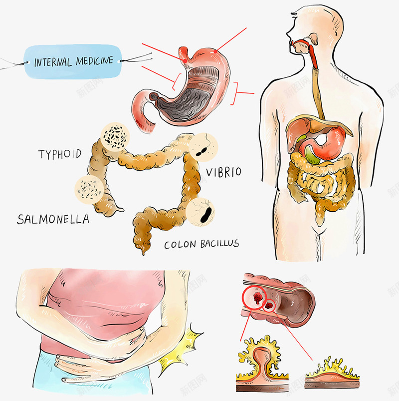 胃部病变医疗插画png免抠素材_新图网 https://ixintu.com 人体器官 插图 胃肠 腹痛