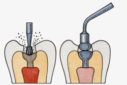 牙根手术插图素材
